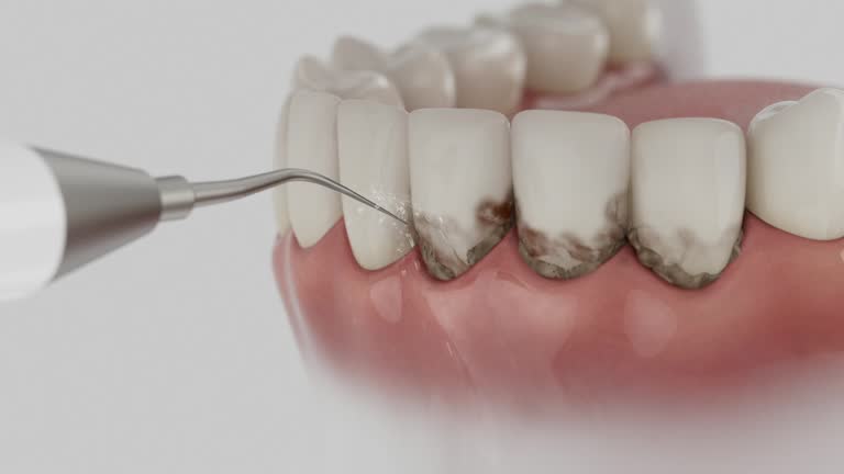 Trusted Wisdom Tooth Removal service in Mount Vernon, GA - Dentist Open Now